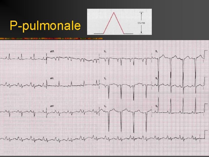 P-pulmonale 