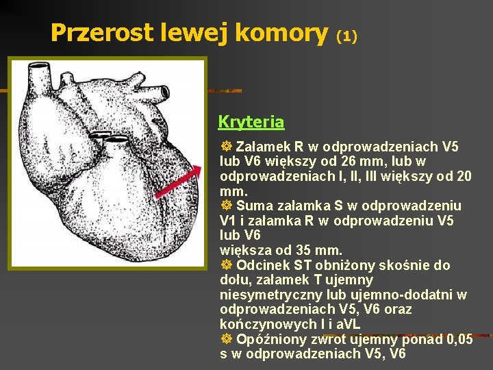 Przerost lewej komory (1) Kryteria ] Załamek R w odprowadzeniach V 5 lub V