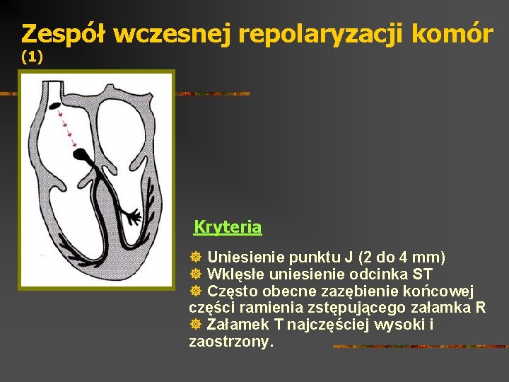 Zespół wczesnej repolaryzacji komór (1) Kryteria ] Uniesienie punktu J (2 do 4 mm)