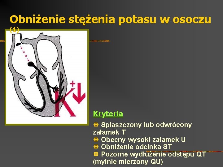 Obniżenie stężenia potasu w osoczu (1) Kryteria ] Spłaszczony lub odwrócony załamek T ]