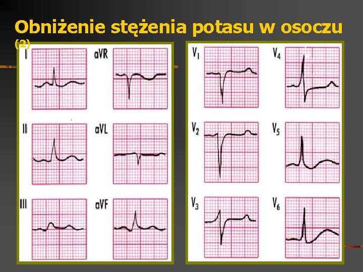 Obniżenie stężenia potasu w osoczu (2) 