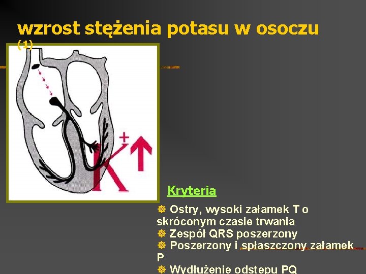 wzrost stężenia potasu w osoczu (1) Kryteria ] Ostry, wysoki załamek T o skróconym