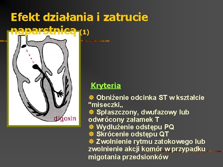 Efekt działania i zatrucie naparstnicą (1) Kryteria ] Obniżenie odcinka ST w kształcie "miseczki„