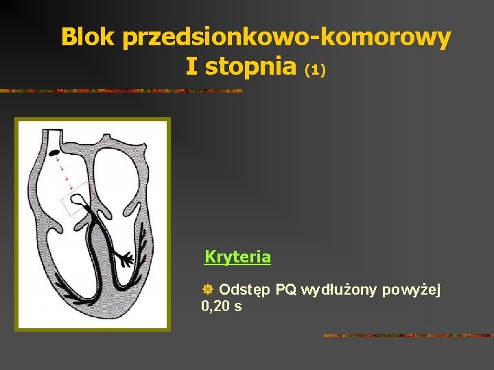 Blok przedsionkowo-komorowy I stopnia (1) Kryteria ] Odstęp PQ wydłużony powyżej 0, 20 s