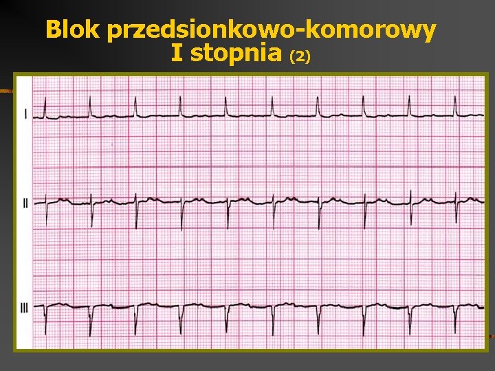 Blok przedsionkowo-komorowy I stopnia (2) 