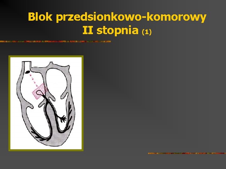 Blok przedsionkowo-komorowy II stopnia (1) 