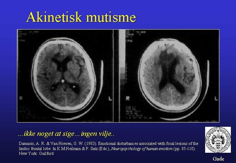 Akinetisk mutisme …ikke noget at sige…ingen vilje. . Damasio, A. R. & Van Hoesen,