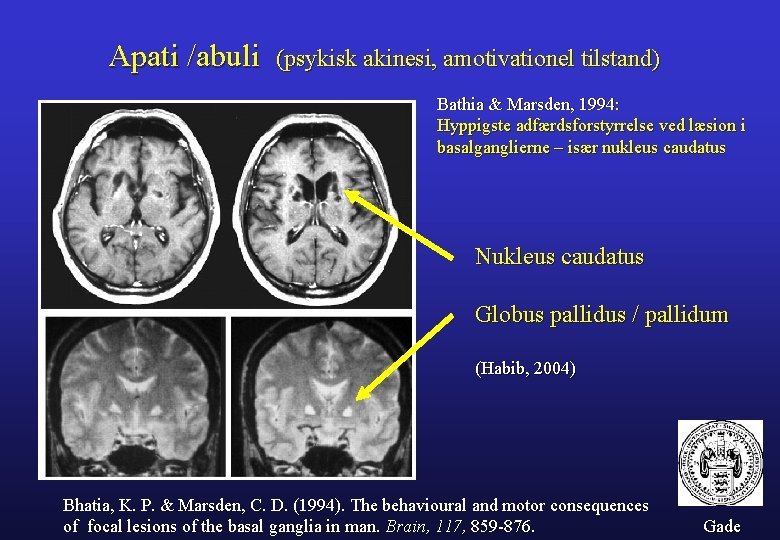 Apati /abuli (psykisk akinesi, amotivationel tilstand) Bathia & Marsden, 1994: Hyppigste adfærdsforstyrrelse ved læsion