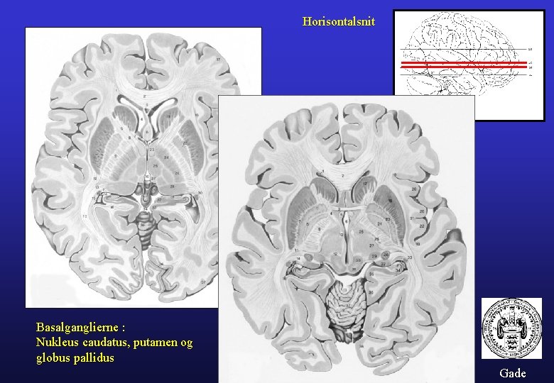 Horisontalsnit Basalganglierne : Nukleus caudatus, putamen og globus pallidus Gade 
