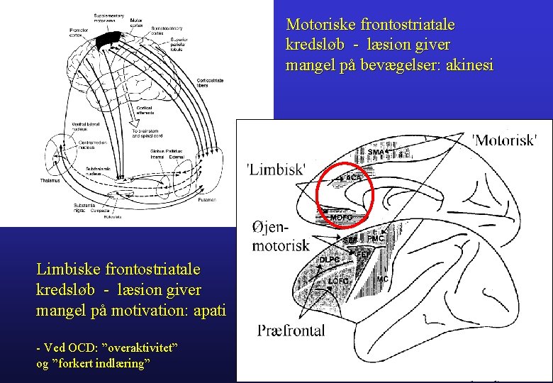 Motoriske frontostriatale kredsløb - læsion giver mangel på bevægelser: akinesi Limbiske frontostriatale kredsløb -