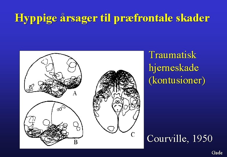 Hyppige årsager til præfrontale skader Traumatisk hjerneskade (kontusioner) Courville, 1950 Gade 