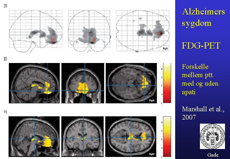 Alzheimers sygdom FDG-PET Forskelle mellem ptt. med og uden apati Marshall et al. ,