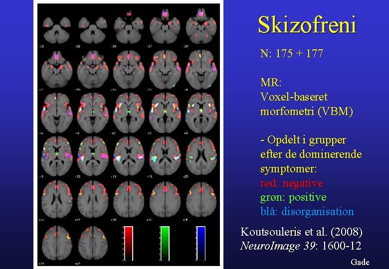 Skizofreni N: 175 + 177 MR: Voxel-baseret morfometri (VBM) - Opdelt i grupper efter