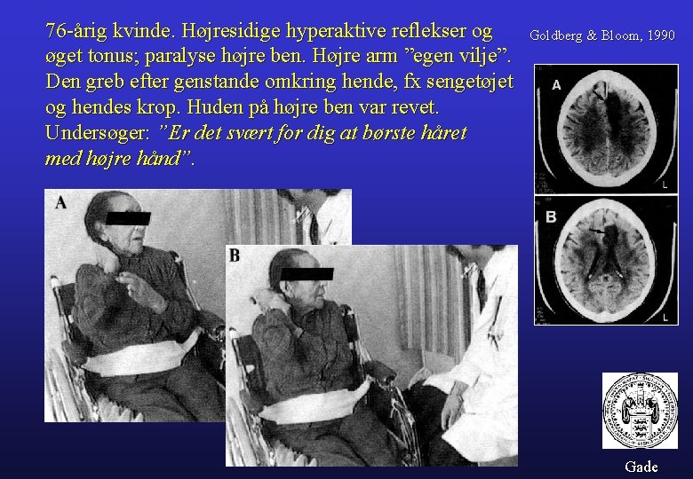 76 -årig kvinde. Højresidige hyperaktive reflekser og øget tonus; paralyse højre ben. Højre arm