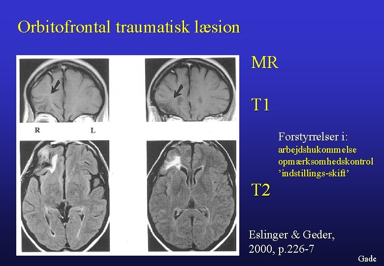 Orbitofrontal traumatisk læsion MR T 1 Forstyrrelser i: arbejdshukommelse opmærksomhedskontrol ’indstillings-skift’ T 2 Eslinger