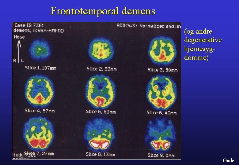 Frontotemporal demens (og andre degenerative hjernesygdomme) Gade 