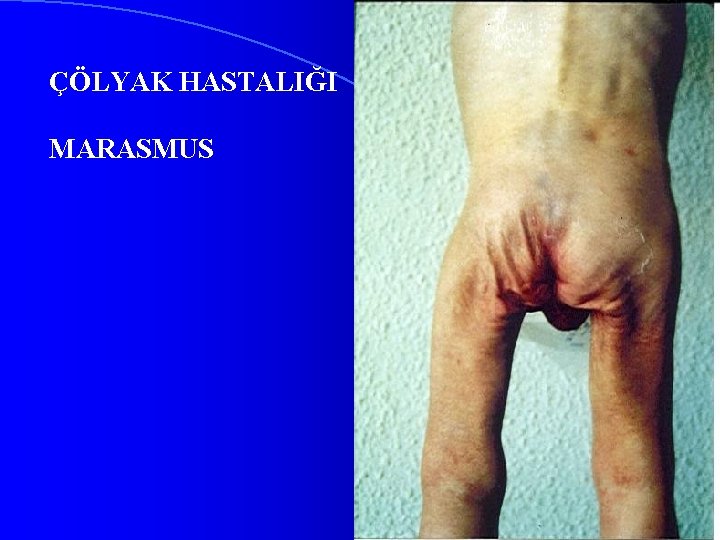 ÇÖLYAK HASTALIĞI MARASMUS 