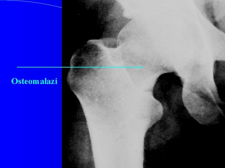 Osteomalazi 
