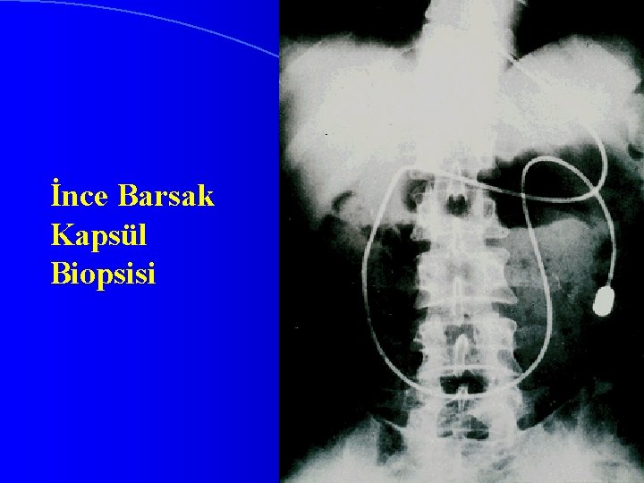 İnce Barsak Kapsül Biopsisi 