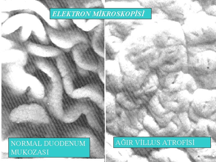 ELEKTRON MİKROSKOPİSİ NORMAL DUODENUM MUKOZASI AĞIR VİLLUS ATROFİSİ 