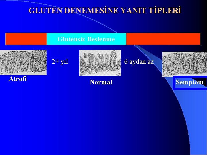 GLUTEN DENEMESİNE YANIT TİPLERİ Glutensiz Beslenme 2+ yıl Atrofi 6 aydan az Normal Semptom