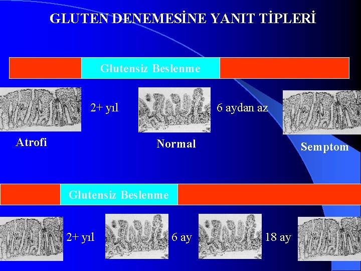 GLUTEN DENEMESİNE YANIT TİPLERİ Glutensiz Beslenme 2+ yıl Atrofi 6 aydan az Normal Semptom