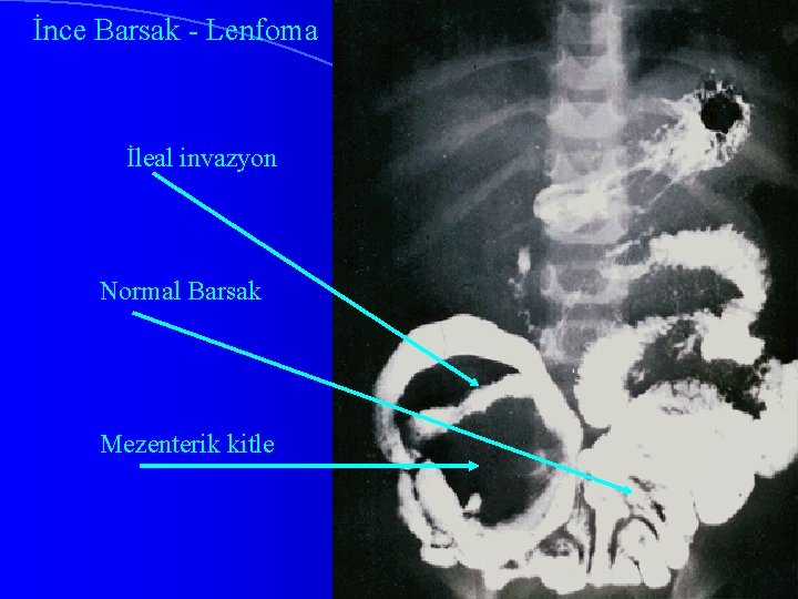 İnce Barsak - Lenfoma İleal invazyon Normal Barsak Mezenterik kitle 