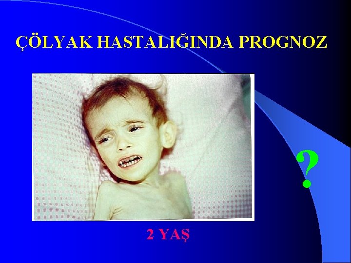 ÇÖLYAK HASTALIĞINDA PROGNOZ ? 2 YAŞ 