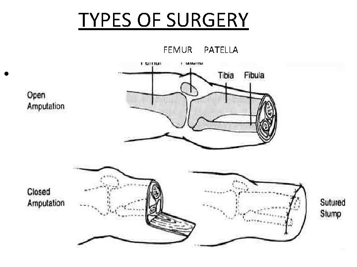 TYPES OF SURGERY FEMUR • femur patella PATELLA 