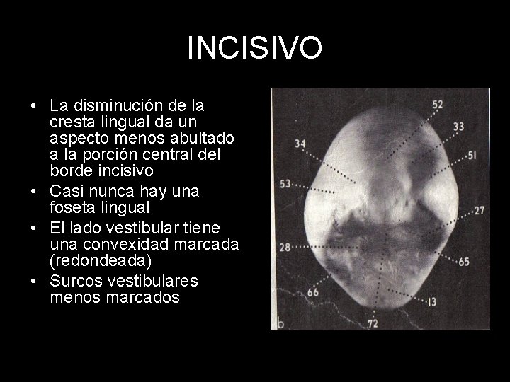 INCISIVO • La disminución de la cresta lingual da un aspecto menos abultado a