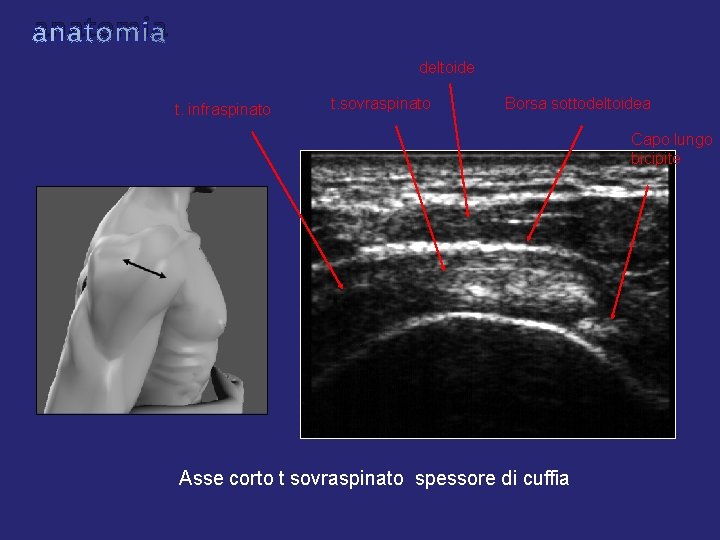 anatomia deltoide t. infraspinato t. sovraspinato Borsa sottodeltoidea Capo lungo bicipite Asse corto t anatomia deltoide t. infraspinato t. sovraspinato Borsa sottodeltoidea Capo lungo bicipite Asse corto t
