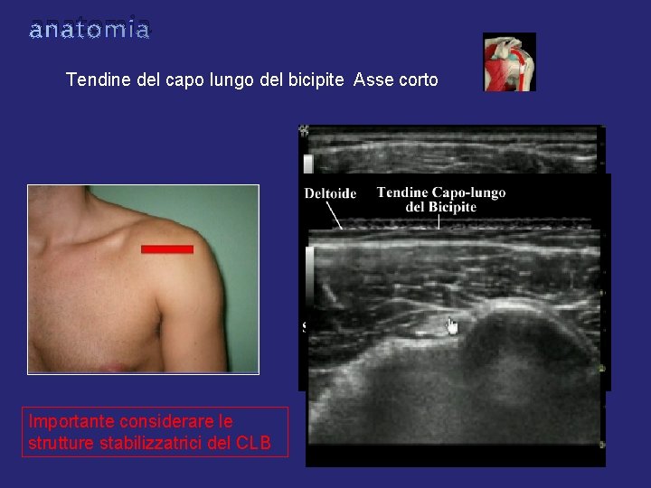 anatomia Tendine del capo lungo del bicipite Asse corto Importante considerare le strutture stabilizzatrici anatomia Tendine del capo lungo del bicipite Asse corto Importante considerare le strutture stabilizzatrici