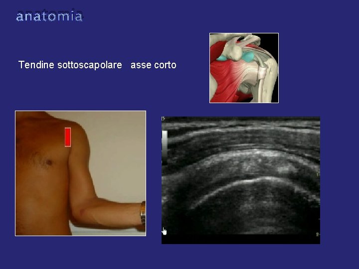 anatomia Tendine sottoscapolare asse corto anatomia Tendine sottoscapolare asse corto