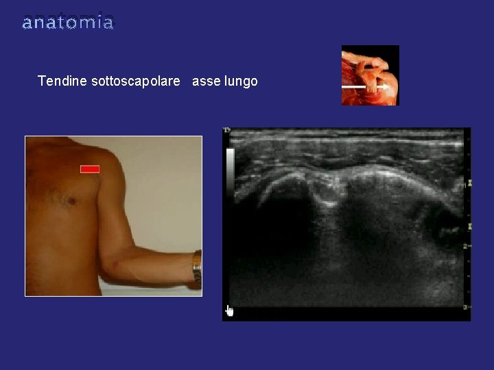 anatomia Tendine sottoscapolare asse lungo anatomia Tendine sottoscapolare asse lungo