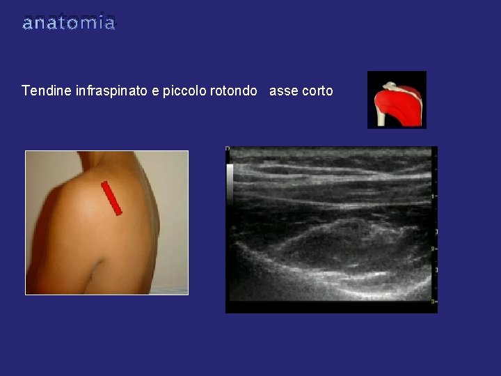 anatomia Tendine infraspinato e piccolo rotondo asse corto anatomia Tendine infraspinato e piccolo rotondo asse corto