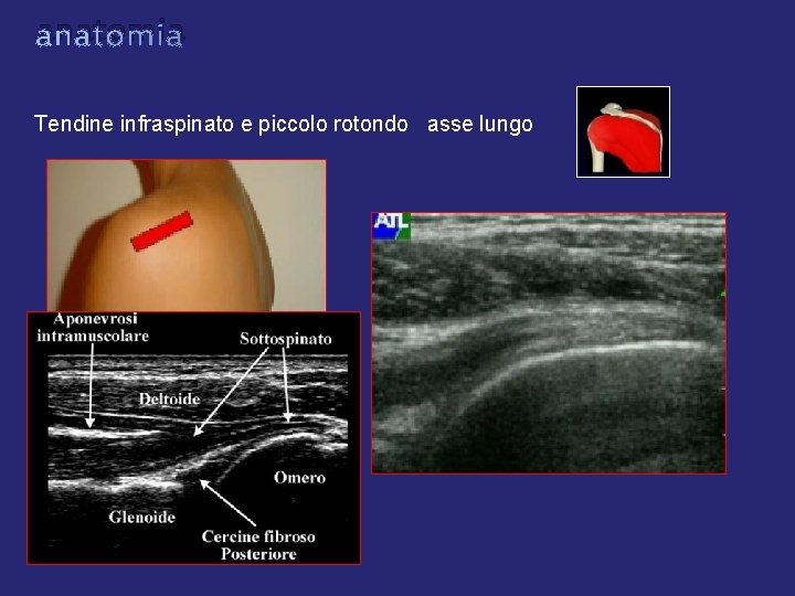 anatomia Tendine infraspinato e piccolo rotondo asse lungo anatomia Tendine infraspinato e piccolo rotondo asse lungo