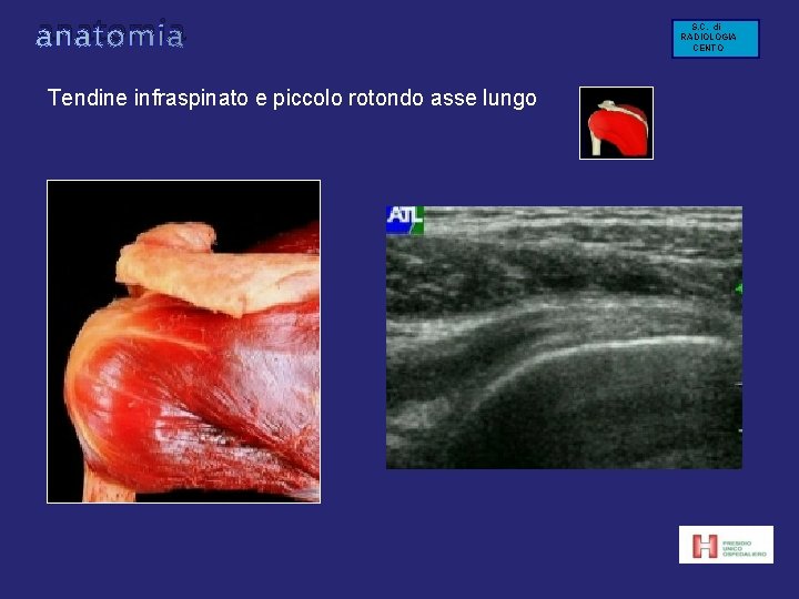anatomia Tendine infraspinato e piccolo rotondo asse lungo S. C. di RADIOLOGIA CENTO anatomia Tendine infraspinato e piccolo rotondo asse lungo S. C. di RADIOLOGIA CENTO
