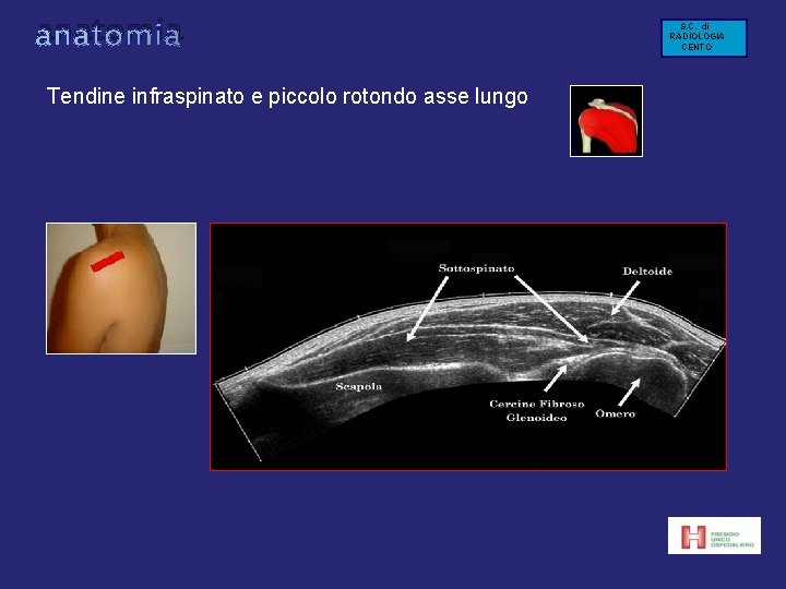 anatomia Tendine infraspinato e piccolo rotondo asse lungo S. C. di RADIOLOGIA CENTO anatomia Tendine infraspinato e piccolo rotondo asse lungo S. C. di RADIOLOGIA CENTO