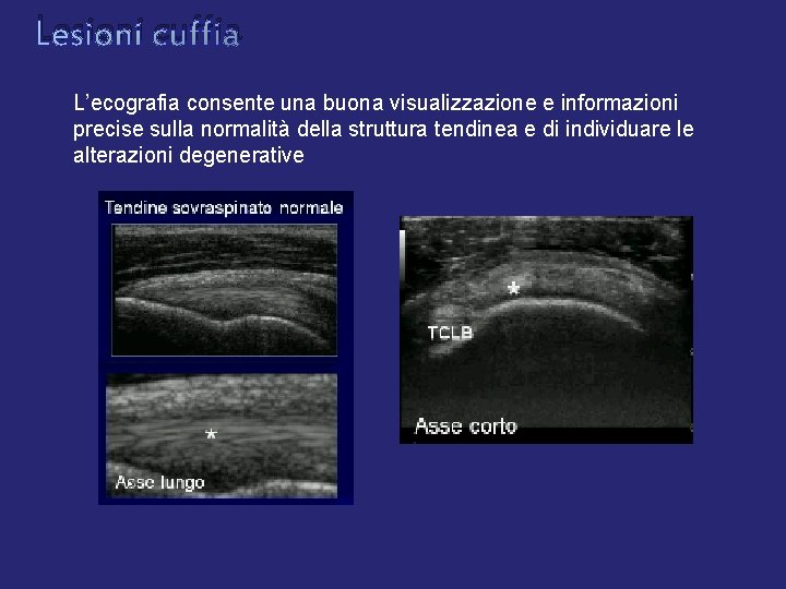 Lesioni cuffia L’ecografia consente una buona visualizzazione e informazioni precise sulla normalità della struttura Lesioni cuffia L’ecografia consente una buona visualizzazione e informazioni precise sulla normalità della struttura