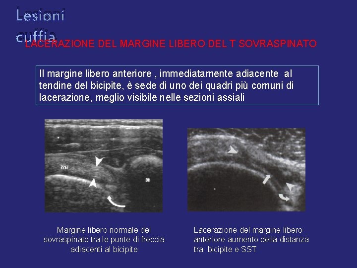 Lesioni cuffia LACERAZIONE DEL MARGINE LIBERO DEL T SOVRASPINATO Il margine libero anteriore , Lesioni cuffia LACERAZIONE DEL MARGINE LIBERO DEL T SOVRASPINATO Il margine libero anteriore ,
