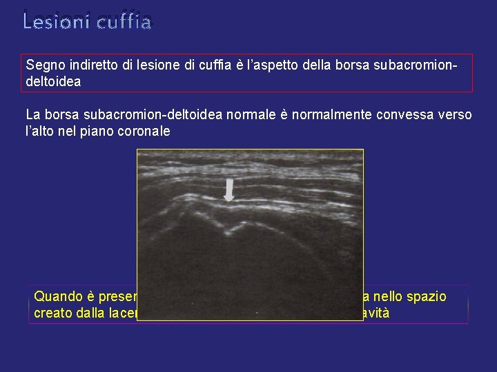Lesioni cuffia Segno indiretto di lesione di cuffia è l’aspetto della borsa subacromiondeltoidea La Lesioni cuffia Segno indiretto di lesione di cuffia è l’aspetto della borsa subacromiondeltoidea La