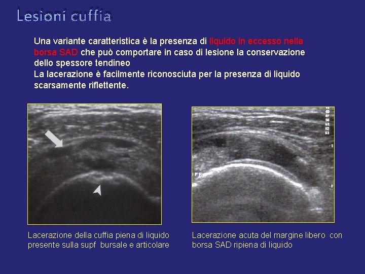 Lesioni cuffia Una variante caratteristica è la presenza di liquido in eccesso nella borsa Lesioni cuffia Una variante caratteristica è la presenza di liquido in eccesso nella borsa