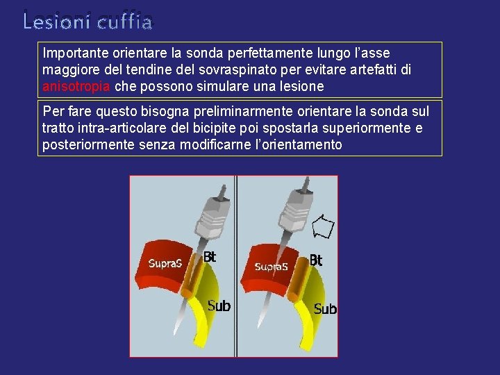 Lesioni cuffia Importante orientare la sonda perfettamente lungo l’asse maggiore del tendine del sovraspinato Lesioni cuffia Importante orientare la sonda perfettamente lungo l’asse maggiore del tendine del sovraspinato