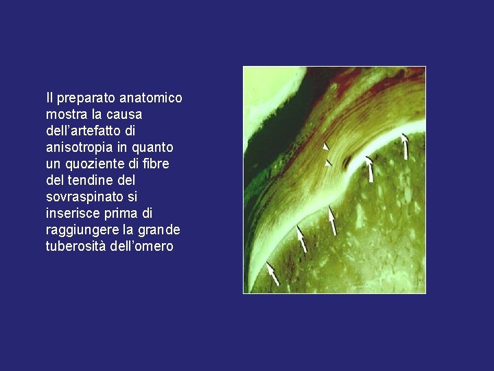 Il preparato anatomico mostra la causa dell’artefatto di anisotropia in quanto un quoziente di Il preparato anatomico mostra la causa dell’artefatto di anisotropia in quanto un quoziente di
