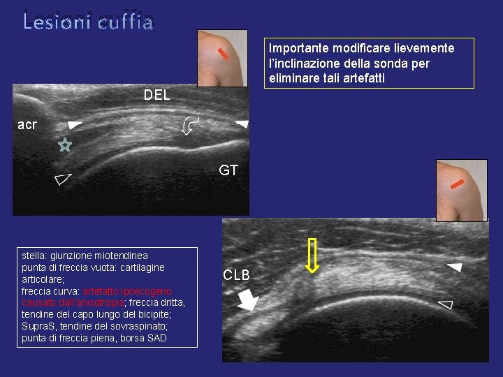 Lesioni cuffia Importante modificare lievemente l’inclinazione della sonda per eliminare tali artefatti DEL acr Lesioni cuffia Importante modificare lievemente l’inclinazione della sonda per eliminare tali artefatti DEL acr