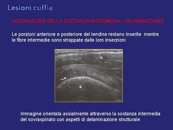 Lesioni cuffia LACERAZIONE DELLA SOSTANZA INTERMEDIA - DELAMINAZIONE Le porzioni anteriore e posteriore del Lesioni cuffia LACERAZIONE DELLA SOSTANZA INTERMEDIA - DELAMINAZIONE Le porzioni anteriore e posteriore del