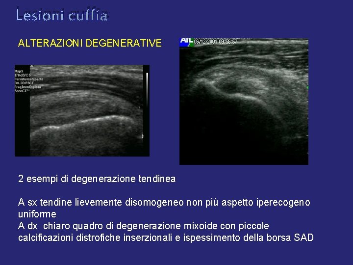 Lesioni cuffia ALTERAZIONI DEGENERATIVE 2 esempi di degenerazione tendinea A sx tendine lievemente disomogeneo Lesioni cuffia ALTERAZIONI DEGENERATIVE 2 esempi di degenerazione tendinea A sx tendine lievemente disomogeneo