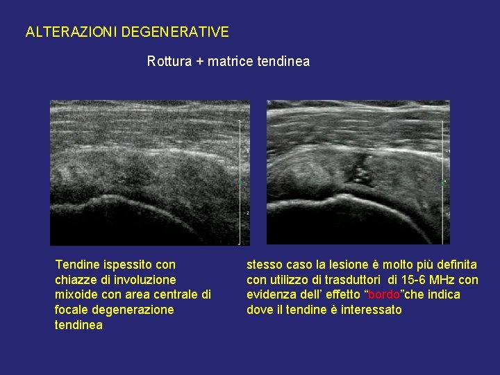 ALTERAZIONI DEGENERATIVE Rottura + matrice tendinea Tendine ispessito con chiazze di involuzione mixoide con ALTERAZIONI DEGENERATIVE Rottura + matrice tendinea Tendine ispessito con chiazze di involuzione mixoide con