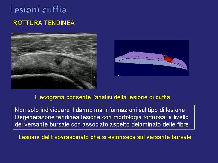 Lesioni cuffia ROTTURA TENDINEA L’ecografia consente l’analisi della lesione di cuffia Non solo individuare Lesioni cuffia ROTTURA TENDINEA L’ecografia consente l’analisi della lesione di cuffia Non solo individuare