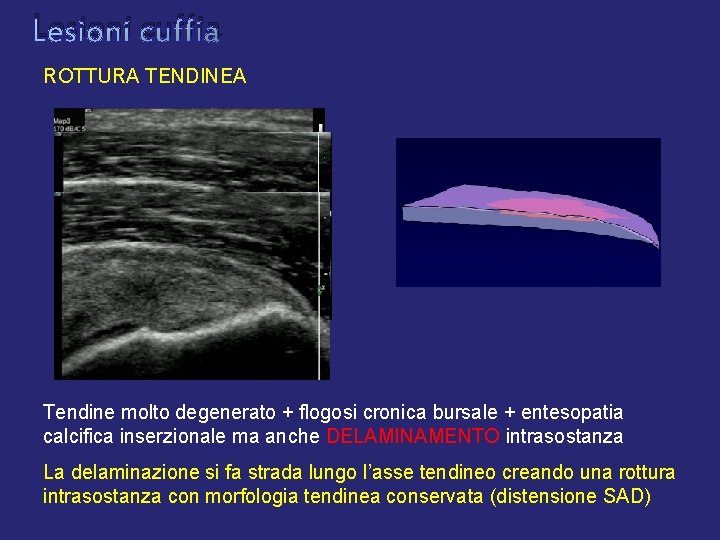 Lesioni cuffia ROTTURA TENDINEA Tendine molto degenerato + flogosi cronica bursale + entesopatia calcifica Lesioni cuffia ROTTURA TENDINEA Tendine molto degenerato + flogosi cronica bursale + entesopatia calcifica